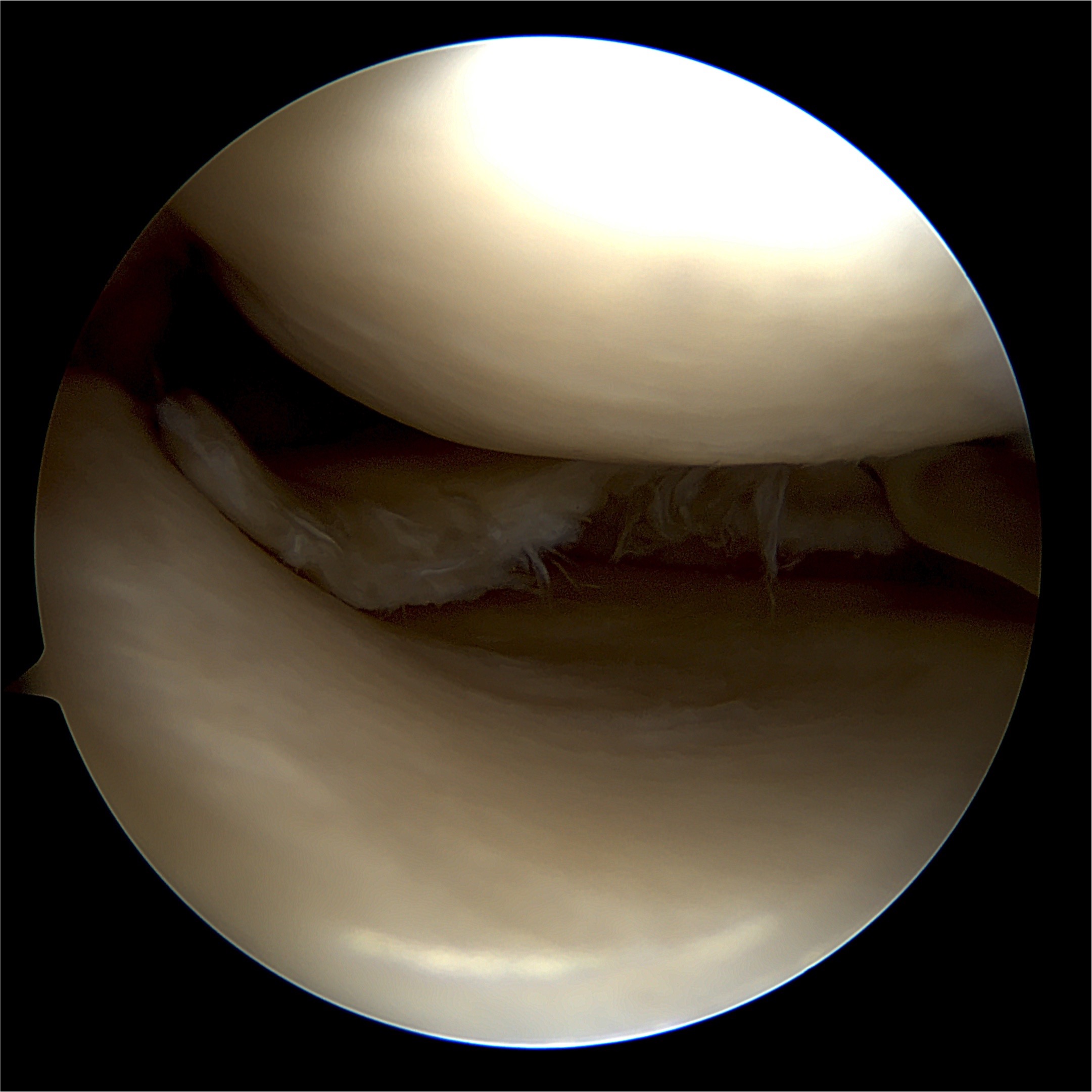 resection de la lesion méniscale.