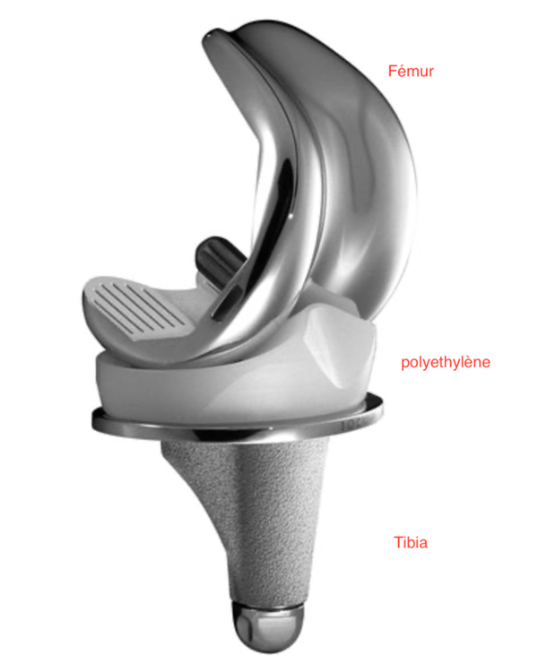 Reprise de prothese totale du genou